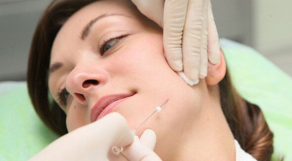 Zdvíhanie nití - metóda kozmetického omladenia tváre po 45 rokoch