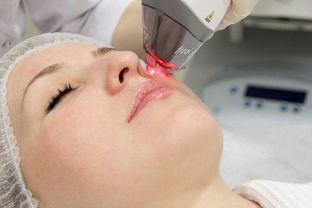 Proces omladenia pokožky tváre pomocou frakčného laseru