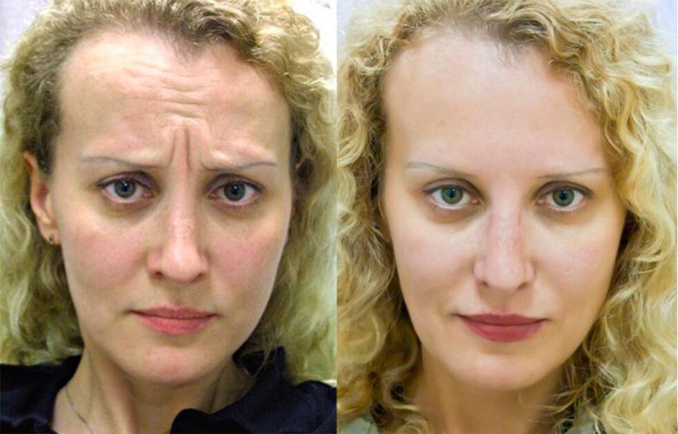 pred a po použití maséra na omladenie ltza foto 1