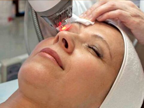laserové omladenie pokožky okolo očí