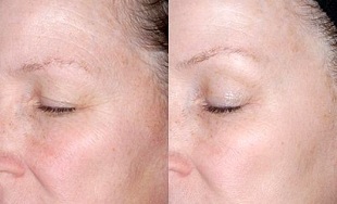 omladenie pokožky okolo očí pred a po fotografiách