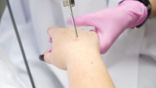 Laserové omladenie pokožky rúk