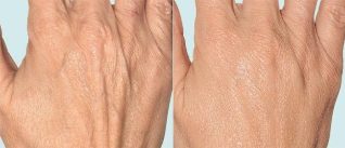 Pokožku ruky pred a po frakčnej terapii