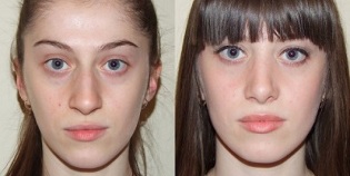 pred a po omladení pokožky plazmou